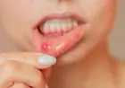 Best Ways To Get Rid Of Ulcers
